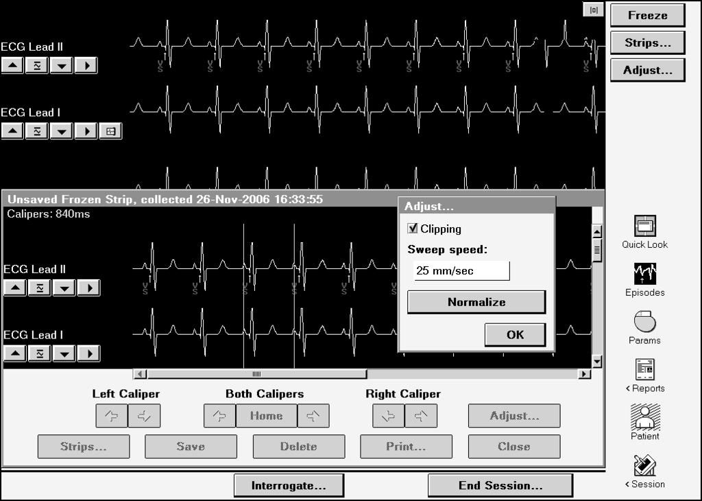Figure 15. Interpreting the frozen strip viewing window 1 [Freeze] freezes a real-time ECG and displays it in the frozen strip viewing window.