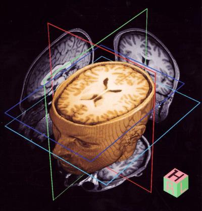 Introduction : Magnetic Resonance Imaging (MRI) Brain analysis: