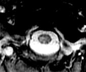 AJR 199: 157-162, 2012 Cord MRI Sagittal T 2