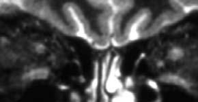 Orbital MRI Fat-Sat T 2 STIR Fat-Sat Post-Gad