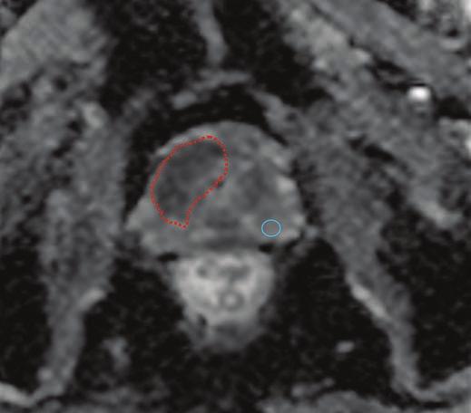 ADC value of benign left peripheral zone (blue line) is 1.37 10 3 mm 2 /s. B, ADC map obtained after treatment reveals increased tumor (red line) ADC value (0.