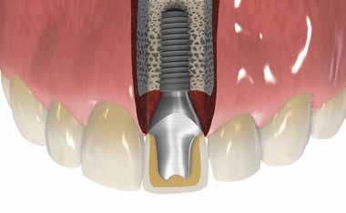 2 Why choose Straumann CARES Abutments Each patient is unique and each clinical situation is different. with Straumann CARES Abutments, you can: A.