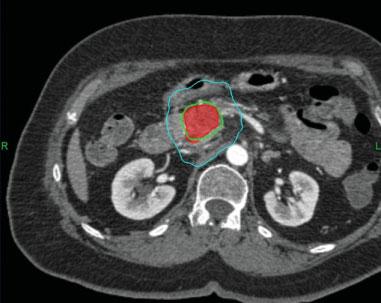 Stereotactic RT Pancreatic Cancer/Chang et al did not undergo underwent surgery because their tumors did not become resectable on post-treatment imaging.