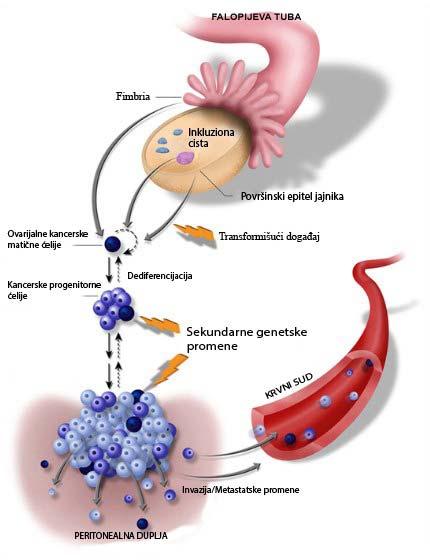 Uvod Slika 2. Shematski prikaz kancerskih maticnih celija kod karcinoma jajnika. (Kurman RJ, Shih IeM. Hum Pathol 2011;42:918-31.