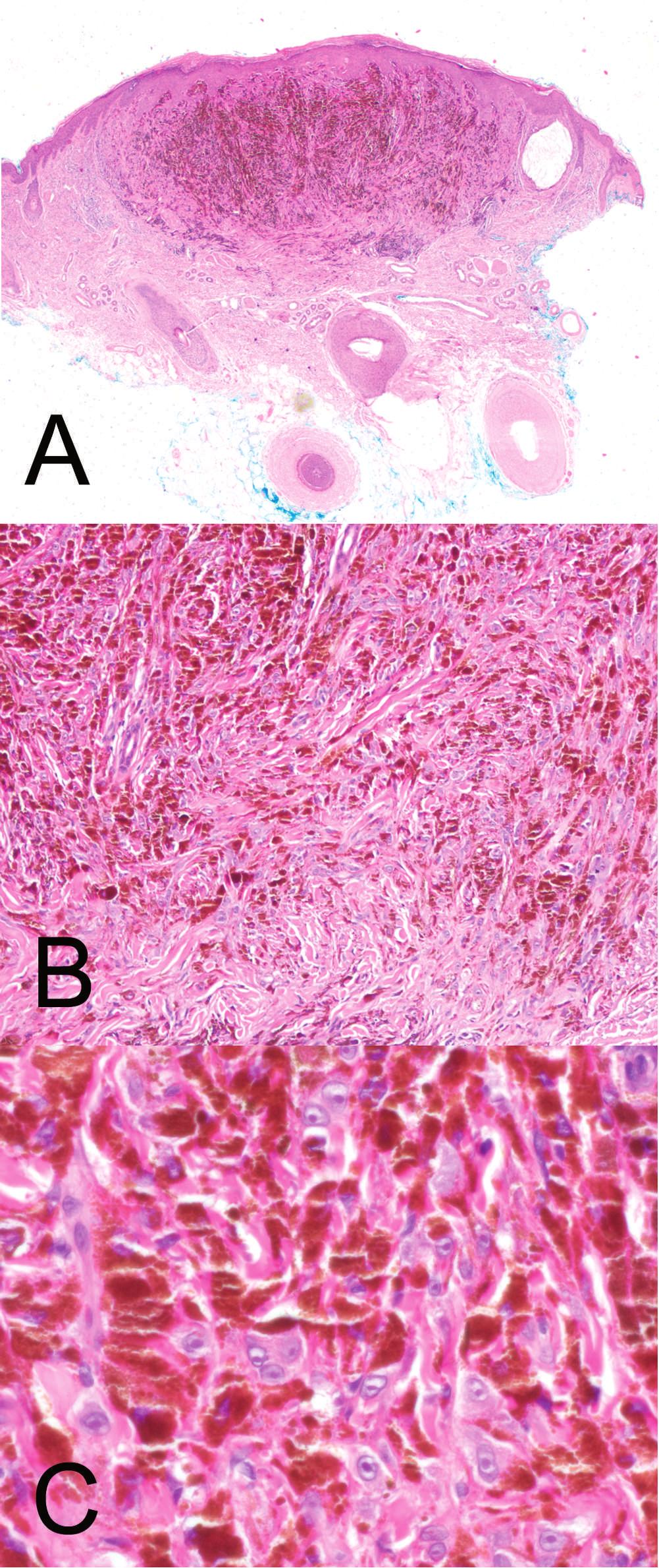 Figure 1. Skin biopsy specimen of a deeply pigmented skin lesion on neck from a 46-year-old man, which was diagnosed as pigmented epithelioid melanocytoma. A sentinel node biopsy was not performed.