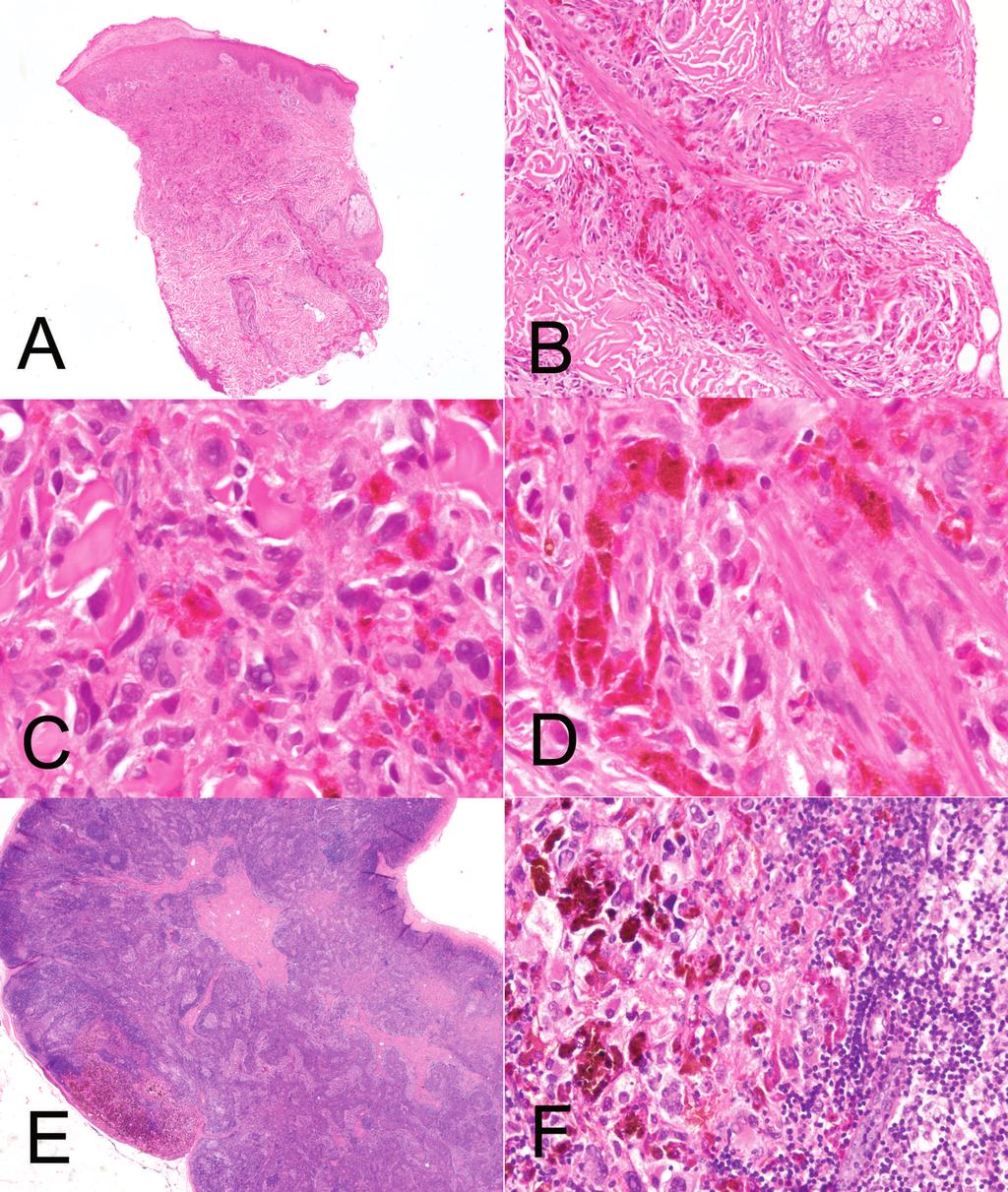 Figure 2. Skin biopsy specimen of a pigmented skin lesion on the left thigh from an 11-year-old girl, which was diagnosed as borderline deeppenetrating tumor.