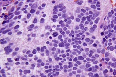 FIGURE 3. Cytokinesis (asterix) during tumor cell division in metastatic neuroblastoma (HE, x1000). SLIKA 2. Metafazno jedro (zvezdica) u metastazi neuroblastoma u limfnom čvoru (HE, 1000). FIGURE 2.