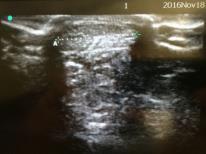 82 Achilles tendon measurements Sagittal and coronal diameters measured bilaterally at the insertion (0), 2cm, 4cm and 6cm proximally