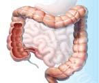 Budesonide Metabolism and Characteristics 1,2 Oral budesonide ph release: ileum/right colon MMX: pan-colonic ~1%