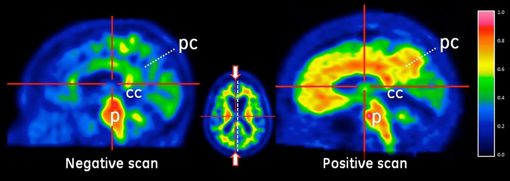 Figure 2: Sagittal view of negative (left) and positive (right) Vizamyl scans. The sagittal slices are slightly off midline in one hemisphere and shown using a rainbow color scale.