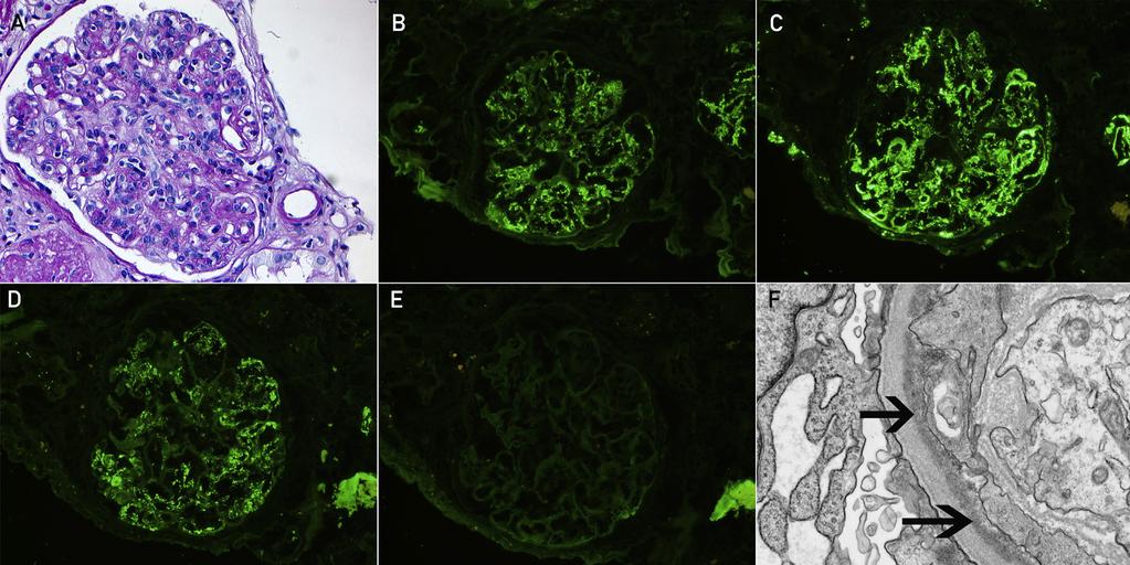 MONOCLONAL GAMMOPATHY AND PROLIFERATIVE GLOMERULONEPHRITIS DIRECT MECHANISM In the direct mechanism, proliferative glomerulonephritis results from the deposition of the monoclonal immunoglobulin and