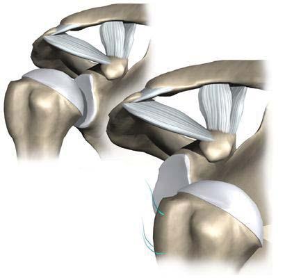 The Shoulder Instability Book Frank Norberg, MD Twin Cities Orthopedic 4010 West 65th Street Edina, MN 55435 Phone #: 952-920-0970 Fax