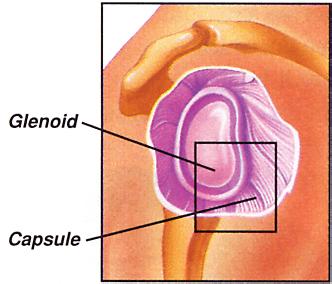 4. Labral Tears When it pushes all or partway out of the glenoid, the humeral head can tear the labrum.