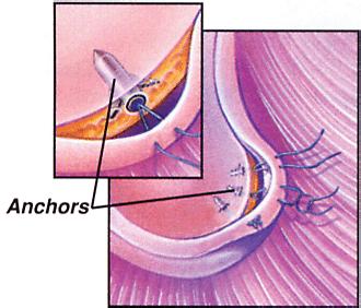 Repair with Surgical Anchors Instead of putting sutures directly through the glenoid, Dr. Norberg commonly uses surgical anchors. Surgical anchors are inserted into small holes drilled in the glenoid.