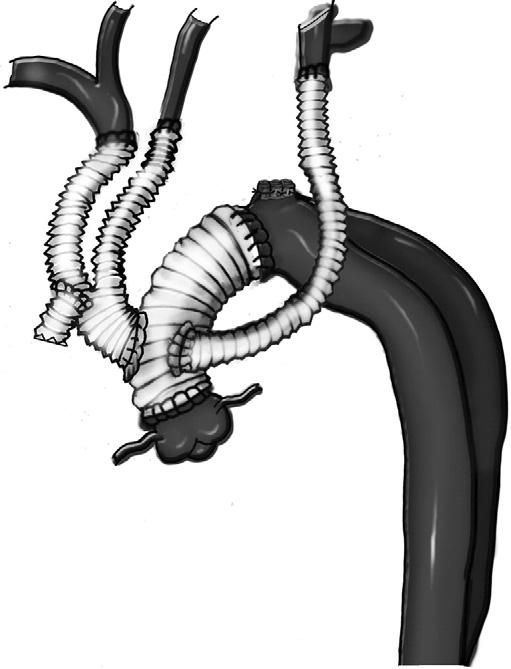 The sinuses of Valsalva involved in the dissection were then reinforced with Teflon felt as a neomedia and the aortic root repaired using a sandwich of felt to obliterate the false lumen.