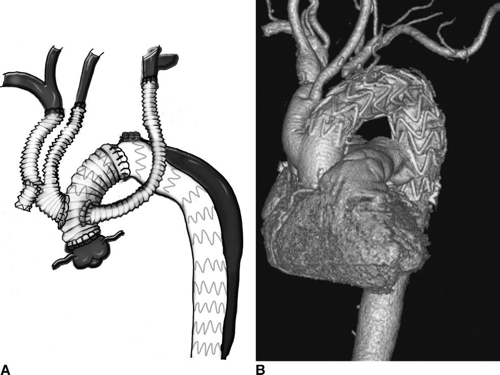 1850 MARULLO ET AL Ann Thorac Surg DEBAKEY TYPE I AORTIC DISSECTION 2010;90:1847 53 Fig 3. (A) Second stage endovascular stenting graft repair.
