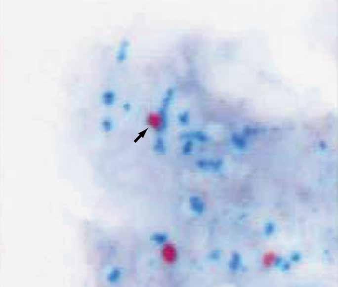 Hematopathology / Original Article F G H J I Frequently, the signal patterns wrapped