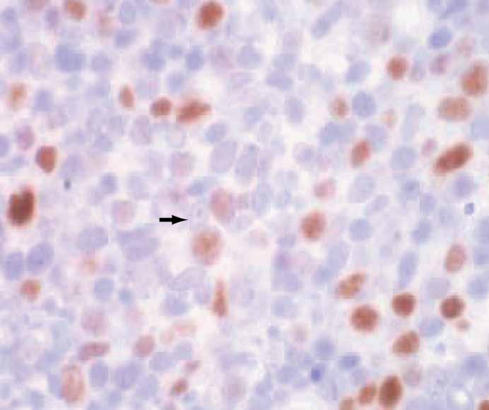 the underlying lymphocytes (upper right). I, Tonsil control, 4.