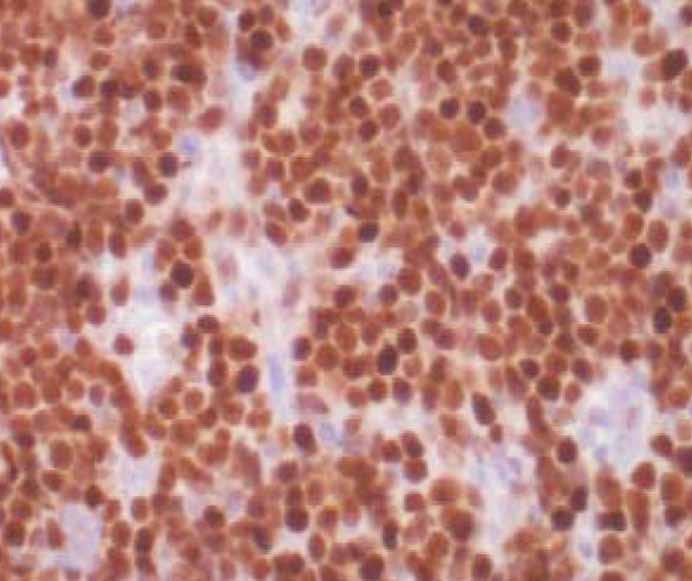 negative follicular dendritic cells (arrow), and negative histiocytes. J, DLBCL, 4.