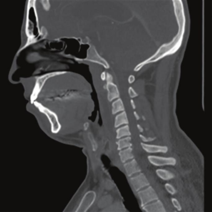retropharyngeal fluid collection with no rim enhancement extending from C2 to C6 ( and (c))