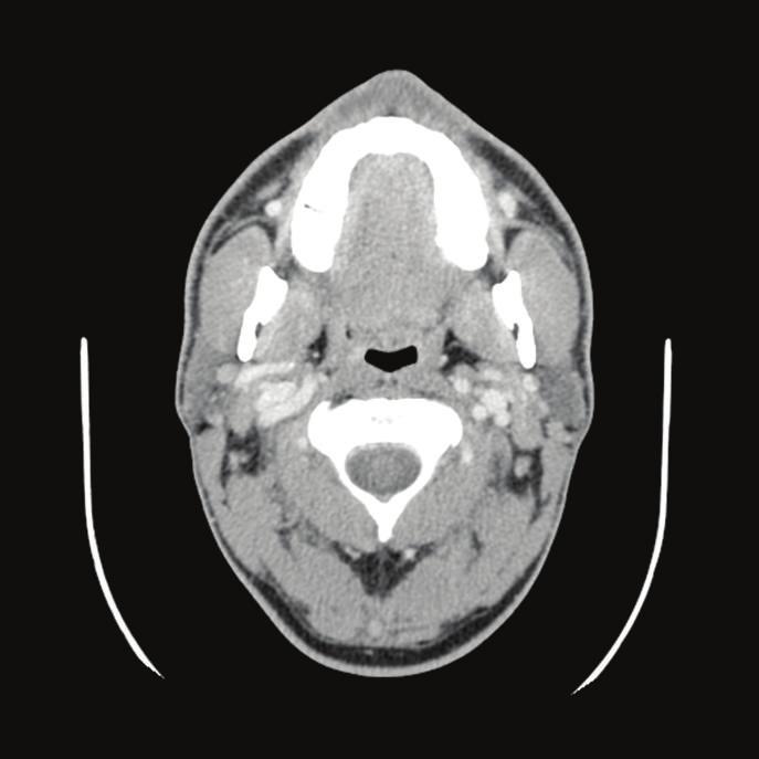 Case Reports in Otolaryngology 3 (c) Figure 3: CT scan of the neck with contrast (axial and sagittal views) demonstrating resolution of the retropharyngeal fluid collection ( and (c)) and