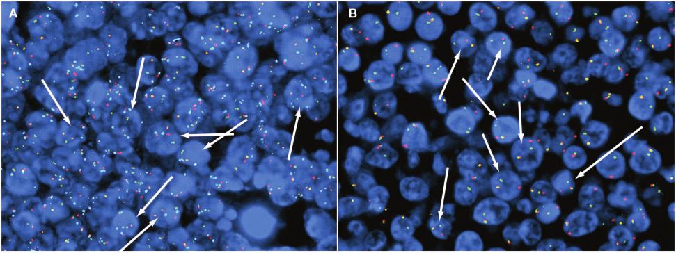 Image 2 Imaging of fluorescence in-situ hybridization studies performed on the paraffin section of the right renal mass of our patient, a 4-year-old boy.