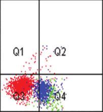 E, CD19 versus CD45 dot plot; The normal B cells (red in the right upper quardrant) show slightly dimmer CD19 expression, which is seen