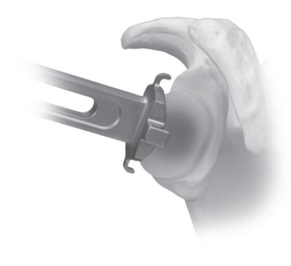 8 Trabecular Metal Glenoid Surgical Technique Implantation Implantation Option Option 1: Back Side Poly Cementing Option 2: Full Glenoid Vault Cementing Option 3: Non-Cemented (Press-Fit) Application