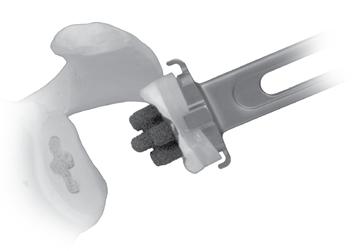 Care should be taken to maintain pressure on the glenoid with the instrument until the cement has hardened. Carefully remove the inserter by toggling the inserter anteriorly to release the tabs (Fig.