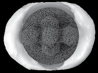 de Poly Cementing (APPROVED FOR USE IN THE U.S. AND OUTSIDE THE U.S.) Remove the Trabecular Metal Glenoid Provisional and use pulsatile lavage, such as the Pulsavac Wound Debridement System, to irrigate the glenoid vault.