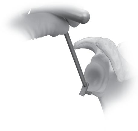 Trabecular Metal Glenoid Surgical Technique 11 Assessing Trabecular