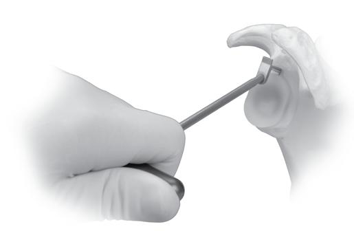 Upon immediate impaction, use of the Trabecular Metal Check Gauge (Fig.