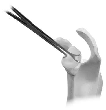 Maintain pressure on the glenoid with the pusher or thumb until the cement has hardened.