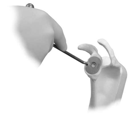 2 Trabecular Metal Glenoid Surgical Technique Glenoid Preparation Precise placement of the glenoid component is more technically demanding than placement of the humeral component.