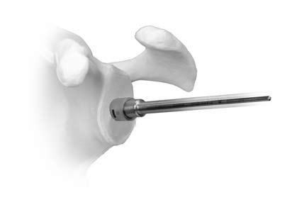 holes is accomplished by inserting the appropriate size Trabecular Metal Glenoid Drill Guide into the prepared 6mm hole and aligning it to the glenoid face.
