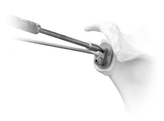 5mm Pin and drill until the housing collar is flush to the glenoid face (Fig. 13). The 6mm Cannulated Drill and the 2.5mm pin are now removed. Fig.