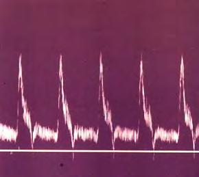 Spectral Doppler Analysis The Basis For Diagnosis Peak systolic velocity (PSV) End diastolic velocity (EDV) ICA / CCA peak systolic velocity ratio Post-stenotic