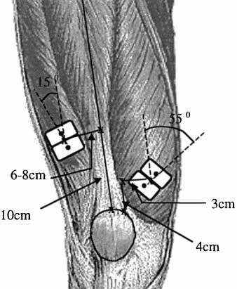 184 ELECTROMYOGRAPHIC ONSET OF VMO RELATIVE TO VL IN PFPS, Cowan dent. All subjects were aged 40 years or younger, to reduce the likelihood of osteoarthritic changes in the patellofemoral joint.