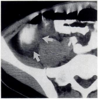 Fig. 1.-9-year-old child with a perirectal abscess.