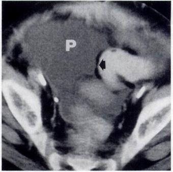 A, Longitudinal sonogram of cecum shows diffuse thickening of bowel wall (arrows).