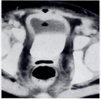 An uncommon complication is formation of a stricture and subsequent obstruction of the small bowel (Fig. 13).