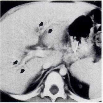 CT scan through upper part of pelvis gram of right lower quadrant (B) show diffuse thickening of wall of small bowel (arrows).