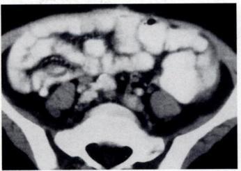 AJR:161, November 1993 COMPLICATIONS AFTER BONE MARROW TRANSPLANTATION 1027 Fig. 15.-6-year-old child with recurrent neuroblastoma.