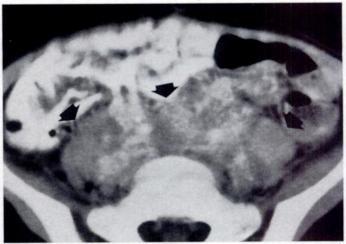 Pathologic examination showed neuroblastoma. Fig. 16.-S-year-old child with recurrent leukemia.