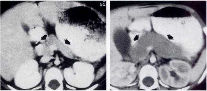 B, Subsequent CT scan obtained after relapse shows diffuse pancreatic enlargement (arrows). A B REFERENCES 1. Teefey 5, Montana MA, Goldfogel GA, Shuman WP.