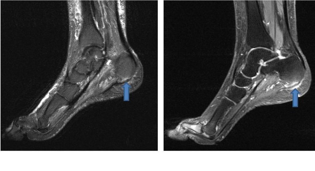 The images reveal deformity and full-thickness tear of the plantar fascia (arrows).