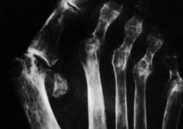 Right foot preoperative radiograph of a 61 year old rheumatoid arthritis patient shows severe hallux valgus deformity with erosive arthritic changes at metatarsophalangeal joint.