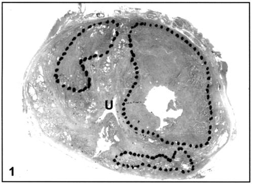 282 Figure 1 Transversal whole-mount histological section of the prostate (case 1) at the level of the verumontaneum (U ¼ Urethra), showing two large cancer foci in the transition zone and a smaller