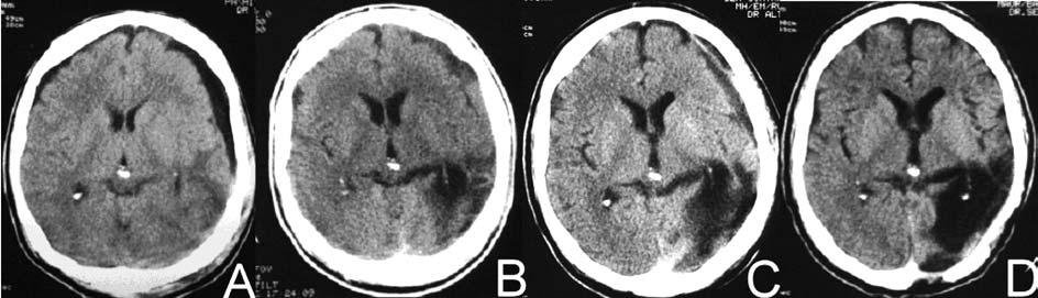 Arq Neuropsiquiatr 2007;65(1) 69 Fig 1. Case 1. (A). CT scan showing left frontal subdural hygroma (9 th day). (B) Enhanced density and heterogeneous appearance (53 rd day).