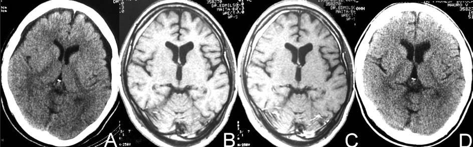 (A) CT scan showing bilateral frontal subdural hygroma (12 th day). (B) MRI (T1-weighted, no contrast) showing laminar subdural hematoma, without compression on the underlying brain (191 th day).